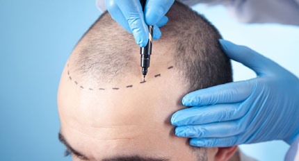Hair Transplantation